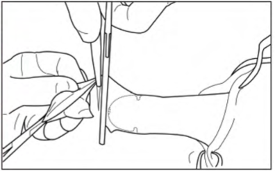 Forceps guided method circumcision centre wales Forceps guided circumcision method