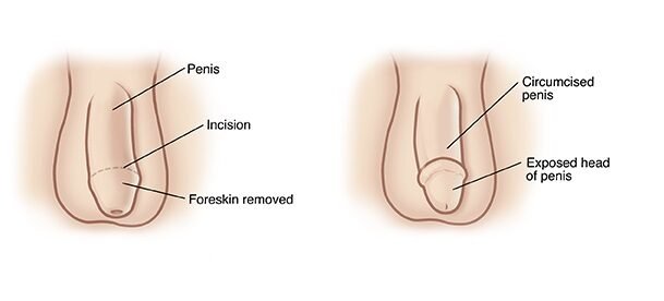 Front view of penis with dotted line showing incision for circumcision.
SOURCE: 5A1862 and 5B1862 uncircumcised v circumcised penis