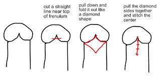 frenuloplasty Frenuloplasty diagram